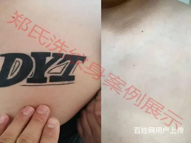 辽阳郑氏洗纹身专洗别处洗不掉的所有纹身签合同包洗净 - 图片 1