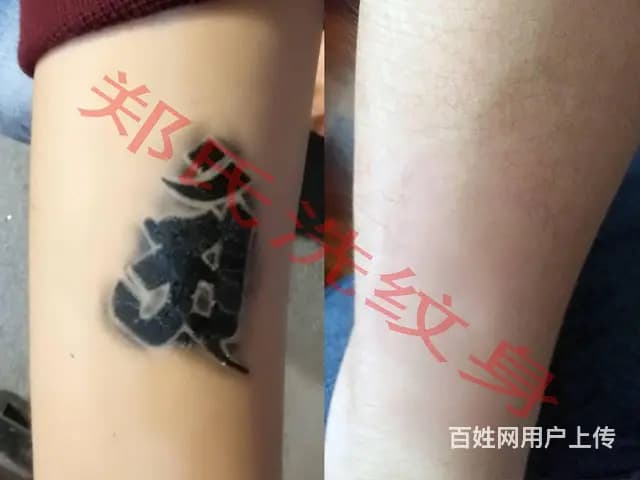 石家庄保定洗纹身洗不掉到辽阳郑氏洗纹身签合同包洗掉 - 图片 8